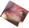 Figure 7  Occlusal view before flap reflection.