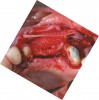 Figure 9 The Regenaform paste molded to the ridge, and the Ossix Plus resorbable membrane ready for positioning over the graft material.
