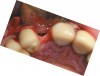 Figure 12  Occlusal view of the lost facial plate after flap reflection.