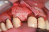 Figure 14  Ossix Plus resorbable membrane in position over the putty.