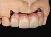 Fig 13. Porcelain-layered zirconia framework (CL-IIIb) with layered pink porcelain for the gingiva (Fig 13); final image in the mouth of the porcelain-layered zirconia framework (Fig 14) (images courtesy of Aram Torosian, MDC).