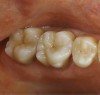 Fig 17. Two-molar full-crown porcelain-fused-to-metal restoration made with a CL-IV substrate.