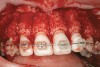 Fig 4. Note gingival inflammation caused by biologic width violation. Provisional restorations were placed on Nos. 6, 8, 9, and 11, and corticotomies were performed from Nos. 3 to 14.