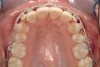 Fig 5. One week postsurgery with mesial buildups on Nos. 5 and 12 and thin pontics on archwire to conceal spaces during closure.