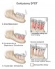 Fig 10. A corticotomy in SFOT is a surgical technique in which only the cortical bone is cut, perforated, or mechanically altered to the depth of the medullary bone and the medullary bone remains intact.