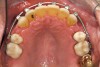 Fig 12 (and Fig 13). Incisors were too upright and had severe incisal wear. He was concerned about esthetics of the worn teeth and his insufficient lip support. Progress photo and panorex 9 months after corticotomies were performed on Nos. 6 through 11. Previous extraction sites were reopened orthodontically to improve function and fill lip support. Incisal edges were restored provisionally with composite resin. Note that despite the creation of adequate spaces to replace missing teeth, there is inadequate room for placement of dental implants because of severe tipping of all the anterior teeth. Osteotomy SFOT may have been a better choice because it would have allowed needed alveoloskeletal correction (without excessive tipping) instead of the primarily dentoalveolar correction common in corticotomy SFOT. Restorative dentist: Brad Jones, DDS.