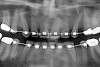 Fig 13 (and Fig 12). Incisors were too upright and had severe incisal wear. He was concerned about esthetics of the worn teeth and his insufficient lip support. Progress photo and panorex 9 months after corticotomies were performed on Nos. 6 through 11.