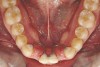 Fig 20. Note lack of alveolar development from congenitally missing Nos. 24 and 25. Surgical procedures after 5 months of orthodontic alignment included single-tooth osteotomies Nos. 6 to 11 and Nos. 21 to 28 and buccal corticotomies on all other teeth. Anchorage plate was stabilized to piriform rim.