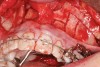 Fig 27. Patient was missing tooth No. 11 and had A-P and transverse maxillary deficiencies with anterior and left posterior crossbites. Bite was opened with glass ionomer cement. Single-tooth osteotomies were performed on teeth Nos. 6 and 12 and multiple-tooth osteotomies were completed on teeth Nos. 3 to 4, 7 to 10, and 13 to 14.