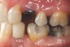 Fig 31. Jackscrews were activated 0.5 mm/day after 5-day latency period. Note pure translation of segments without tipping. Result 8 months postsurgery. Tooth No. 12 was converted to a canine, and an implant was placed in regenerate bone. Note amount of alveoloskeletal correction and increase in volume of maxillary arch. Also note the amount of protraction of maxillary anterior segments while anchorage was maintained in posterior segment. Restorative dentist: Michael E. Carter, DDS.