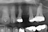 Fig 32. Jackscrews were activated 0.5 mm/day after 5-day latency period. Note pure translation of segments without tipping. Result 8 months postsurgery. Tooth No. 12 was converted to a canine, and an implant was placed in regenerate bone. Note amount of alveoloskeletal correction and increase in volume of maxillary arch. Also note the amount of protraction of maxillary anterior segments while anchorage was maintained in posterior segment. Restorative dentist: Michael E. Carter, DDS.