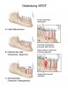 Fig 33. An osteotomy in SFOT consists of surgical cuts through both the cortical and medullary bone and typically indicates the creation of one or more dento-osseous segments.