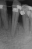 Figure 10  Radiograph of orthodontic distraction osteogenesis.