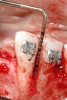 Figure 14  Interproximal bone present at teeth Nos. 21 and 22, postorthodontics.