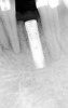 Figure 21  Radiograph of implant in position at the time of surgery of tooth No. 23.