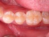 Fig 4. Class II restoration of mandibular second premolar using a self-etch adhesive.
