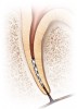 Fig 1. A separated rotary NiTi file can pose a risk of post-endodontic complications.