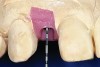 Fig 12 through Fig 14. An implant has been placed at a normal depth relative to the bone and tissue level of the site (Fig 12); however, it will be impossible to create a restoration the same length as the contralateral tooth due to the coronal placement of the implant (Fig 13). As demonstrated in the provisional restoration shown in Fig 14, the tooth length discrepancy is significant.