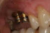 Fig 1. An example of two stock abutments that have been modified with apical and coronal circumferential undercuts.