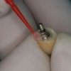 Fig 18. After application of the glaze to the tissue side of the crown/abutment assembly, it is then light polymerized.