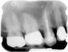 Figure 1  X-ray of an endodontically treated second bicuspid restored with a fiber post, core, and all-porcelain crown.