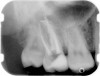 Figure 6  Endodontically treated maxillary right second molar.