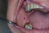 Fig 3. Flat red macules due to cheek biting or nipping present in a patient due to inadequate salivary lubrication.