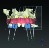 (13) An optical scan of patient’s teeth and diagnostic wax-up was combined with CBCT to facilitate treatment planning of implant placement. Note that there is a need for sinus augmentation to accommodate a dental implant on the right image (blue: tooth contours determined from wax-up/optical impression, red: soft tissue outline).