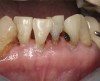 Fig 6. Use of 38% SDF to arrest root caries in permanent teeth of an elderly patient. Fig 6: The arrested root carious lesions were hard to probe.