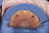 (3.) Labioincisal reduction using the facial reduction matrix. Amalgam restorations on teeth Nos. 7 and 10 were replaced with composite during the preparation phase.