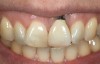 Fig 1. Midfacial recession can affect the esthetics of a smile and lead to an unsatisfactory outcome.