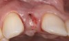 Fig 7. The gingiva was allowed to grow over the cover screw for a 2- to 3-week period. The soft-tissue shape was still deficient and would require a secondary augmentation procedure.