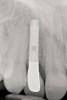 Fig 13. The final radiograph of the seated crown showing a healthy bone level around the implant.