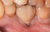 Fig 15. The implant-supported restoration of tooth No. 19 presented with a lack of attached keratinized gingiva, shallow buccal vestibule, and 2 mm of buccal recession.