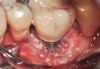 Fig 23. Fill of the infrabony defect with bone xenograft.