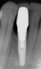 Fig 46. The post-treatment radiograph showing a healthy stable implant and restoration.