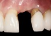 Fig 47. Implant tooth No. 9 was placed too close proximally to tooth No. 10. The result was violation of interproximal biologic width and loss of interproximal attachment that clinically translated into loss of the interdental papillae.