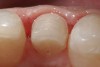 Figure 7  Close-up occlusal view of the Class II veneer preparation with a minimal intervention to modified preparation design.