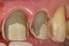 Figure 16  Close-up of an all-ceramic restoration preparation design demonstrating dentin exposure of more than 50%, less than 50% enamel remaining for bonding, and margins with 30% enamel periphery.