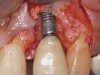 (2.) The implant is fractured, and significant bone loss is evident. This implant required removal and site augmentation to facilitate new implant placement.