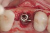 (4.) The implant in the molar position was relatively narrow and failed biomechanically. It was removed with a trephine, and the adjacent fractured bicuspid was also extracted to accommodate an implant. Because sufficient apical bone was present, a wider implant was placed in the molar position. Bone augmentation was performed around both implants.