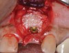 (8.) A cross-linked collagen scaffold consisting of FDBA/DBBM in a 4:1 ratio is placed over the particulate bone graft.