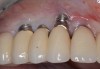 (15.) Due to physiologic remodeling of the alveolar ridge, facially inclined implant positions, and ineffective augmentation at time of placement, these three implants are experiencing mucosal recession.