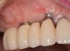 (19.) At 1-month postoperatively, partial coverage of the exposed abutments/implant platforms has occurred. There is now a band of keratinized mucosa, and the patient is instructed in nontraumatic plaque removal protocols. Follow-up to monitor long-term maintenance of the regenerated keratinized mucosa is encouraged.