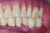 Fig. 9. Class I occlusal relationship. Anterior and posterior teeth in contact. Patient originally had a Class II relationship.