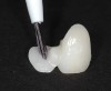 After the bridges were tried in and the intaglio surface of the zirconia wings were sandblasted with 50-μm aluminum oxide at 30 PSI to 40 PSI of air pressure, a 10-MDP dedicated primer was placed and warm-air–dried for 30 seconds.