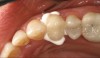 (6.) Crown placed using bioceramic cement (buccal and occlusal views).