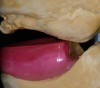 (11.) Enlarged tuberosities compromise the available restorative space.