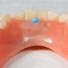 (14.) Placing a dyed resin bump further helps with the development of a normal tongue posture by inducing visual memory.