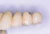 Fig 1. Chipping of veneering porcelain of porcelain-fused-to-gold full-arch fixed dental 
prosthesis.